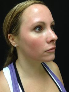 Woman after melanage peel