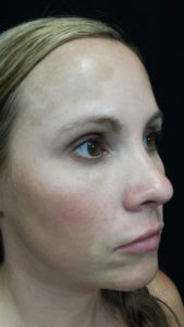 Woman before melanage peel