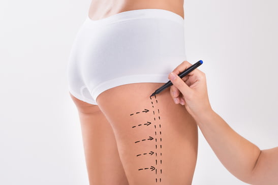 The Best Non-Invasive Alternatives to Liposuction