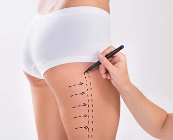 Top 3 Non-Invasive Alternatives to Liposuction in Charlotte