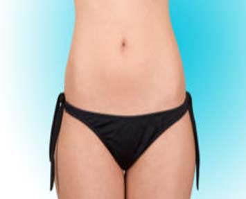 Liposuction vs. CoolSculpting in Charlotte: Which Is Best for You?