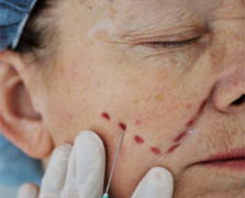 Older woman recieving botox