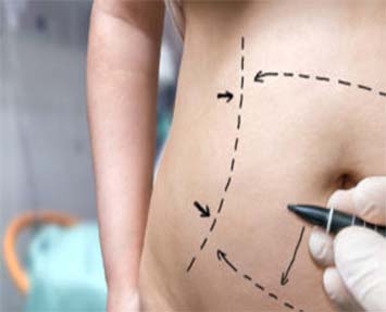 Liposuction vs. CoolSculpting in Charlotte: Which Is Right for You?