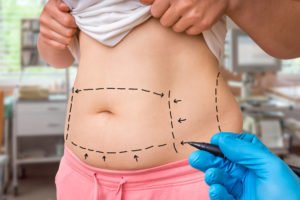 CoolSculpting in Charlotte