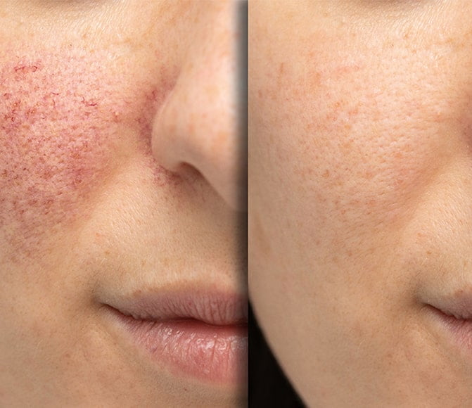 Rosacea Treatment in Charlotte, NC