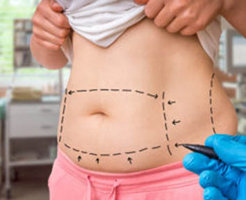 CoolSculpting in Charlotte: How Does It Work – and Is It Effective?