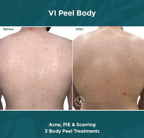 img-before-after-vi-peel-body-acne