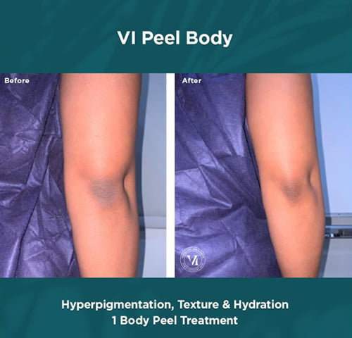 img-before-after-vi-peel-body-hyperpigmentation
