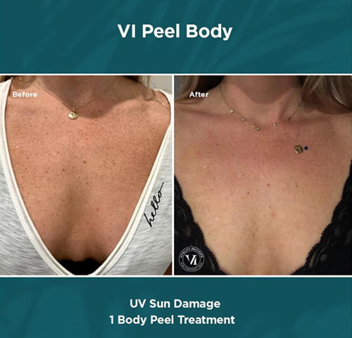 img-before-after-vi-peel-body-uv-sun-damage