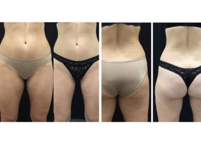 Before and After CoolSculpting Abdomen & Thighs