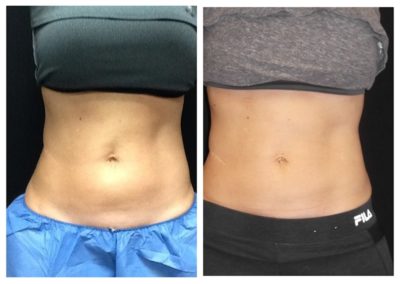 Before and After CoolSculpting Abdomen