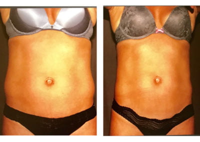 Before and After CoolSculpting Abdomen