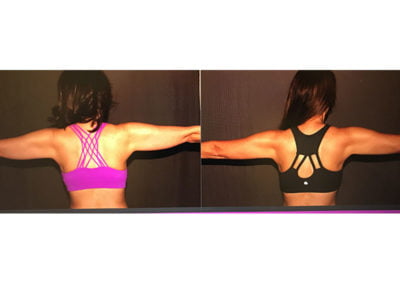 Before and After CoolSculpting Arms