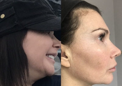 Before and After CoolSculpting Chin