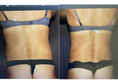 Before and After CoolSculpting Flanks