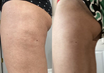Before and After CoolSculpting Thighs