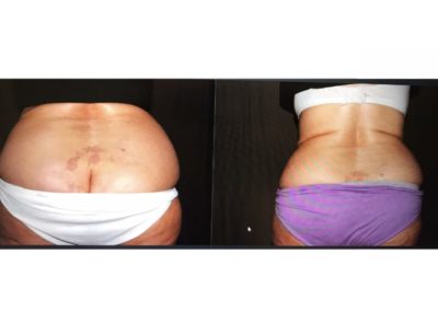 Before and After CoolSculpting Abdomen and Flanks