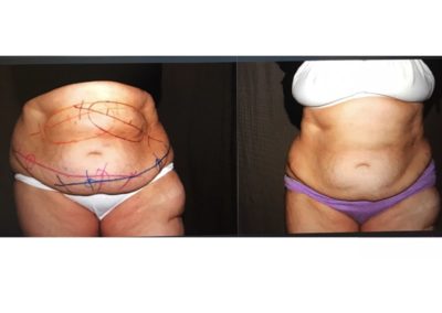 Before and After CoolSculpting Abdomen and Flanks