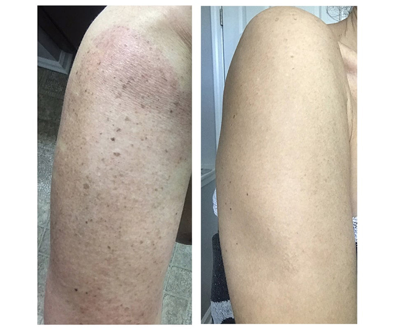 BBL-upper arm
