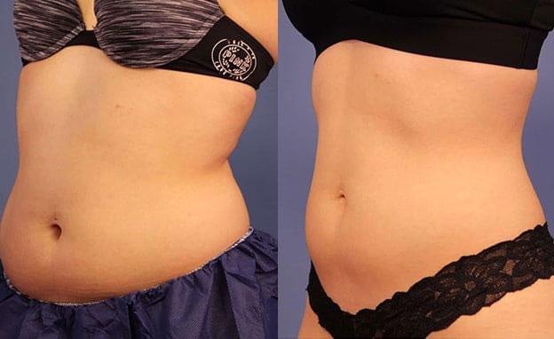 A woman with a slimmer stomach after CoolSculpting Elite in Charlotte