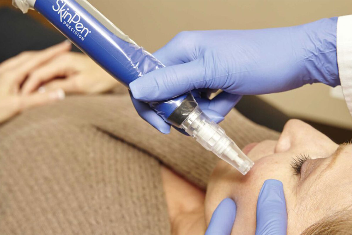 A photo of the SkinPen microneedling in Charlotte